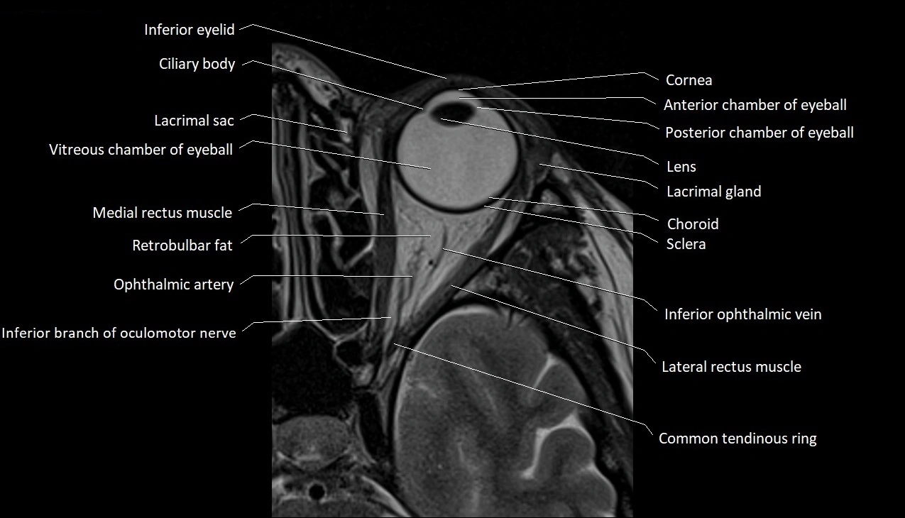 MRI Orbit axial cross sectional anatomy image 7.webp